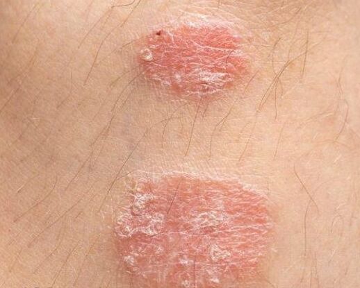 Psoriātisko plāksnīšu parādīšanās