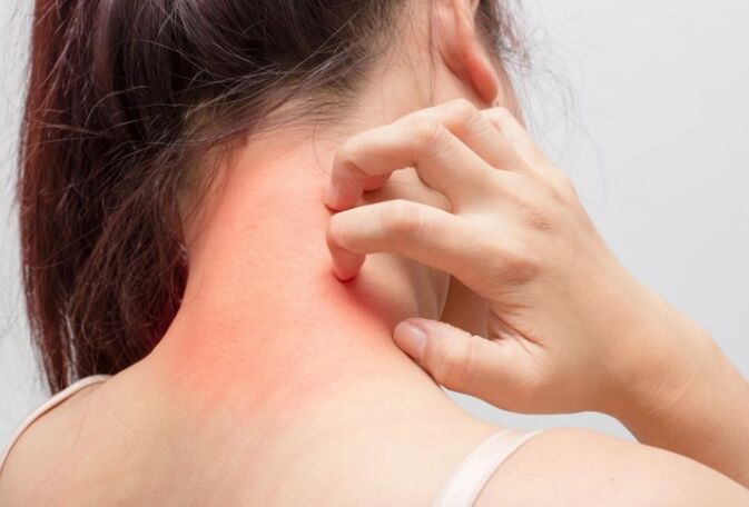 Nieze ir viens no psoriāzes cēloņiem