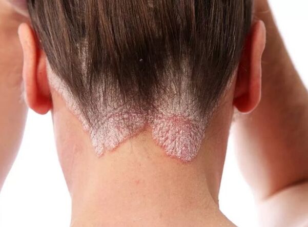 Psoriātiskā erytroderma