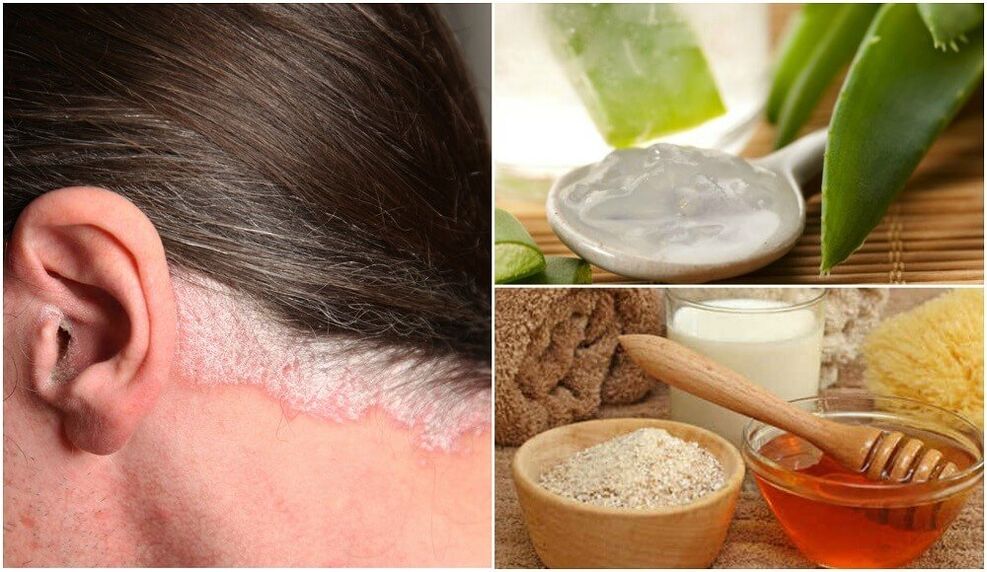 Psoriāzes ārstēšana ar tautas līdzekļiem
