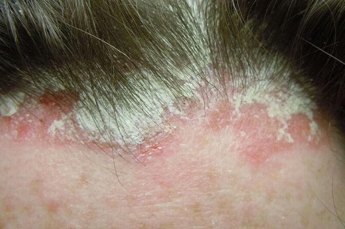 Psoriāze uztver visu mataino galvas daļu