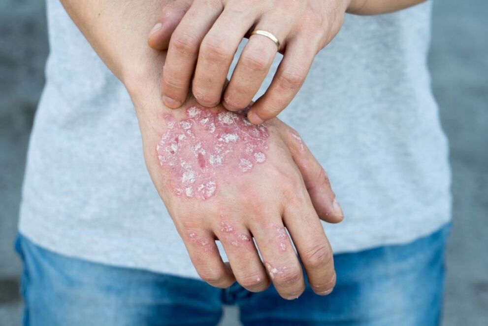 Psoriāze ir