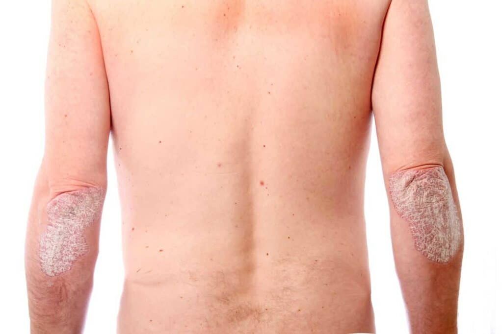Psoriāzes otrais posms