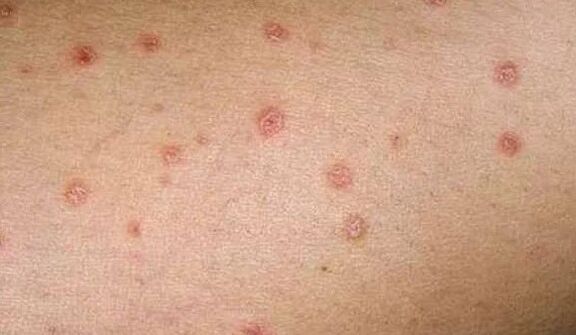 Sākotnējais psoriāzes posms