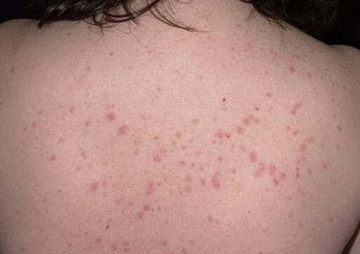 Sākotnējais psoriāzes posms