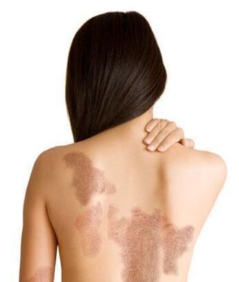 Psoriāzes posmi atkarībā no bojājuma zonas