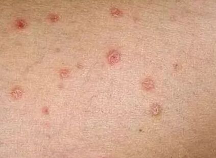 Sākotnējā posma psoriāze