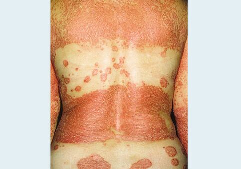 Dzimumorgānu psoriāze
