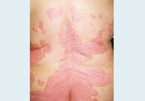 Muguras psoriāze