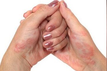 Psoriāze rokās