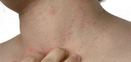 Psoriāze uz kakla
