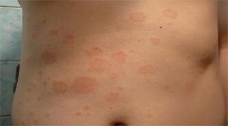Psoriāze uz vēdera