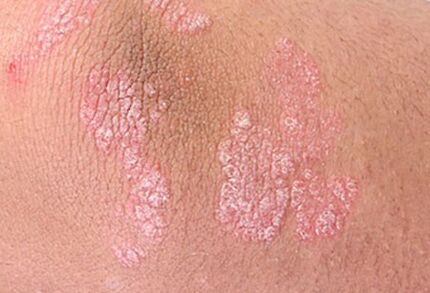 psoriāze