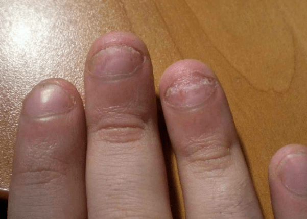 Nagu psoriāze