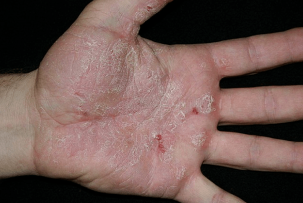 Psoriāze rokās