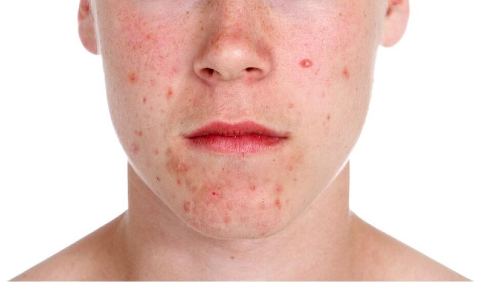 Psoriāze uz sejas