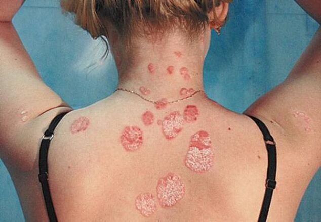 Psoriāze aizmugurē