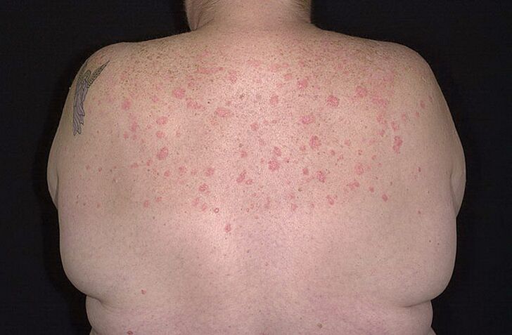 Psoriāze uz pleciem