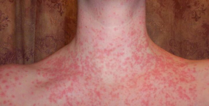 Psoriāze uz ķermeņa