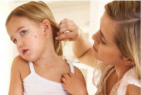Psoriāzes sākotnējās posma foto