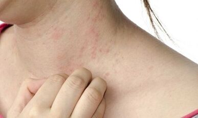 psoriāzes ārstēšana progresējošā stadijā