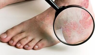 psoriāzes ārstēšanas iespējas