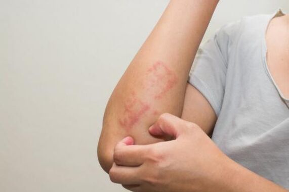 Jaunākās psoriāzes ārstēšanas metodes