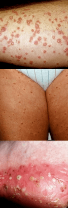 Psoriāze uz kājām