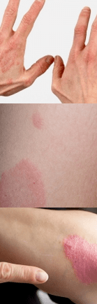 Sākotnējās skatuves psoriāze uz rokām