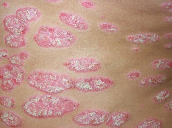aplikuma psoriāze