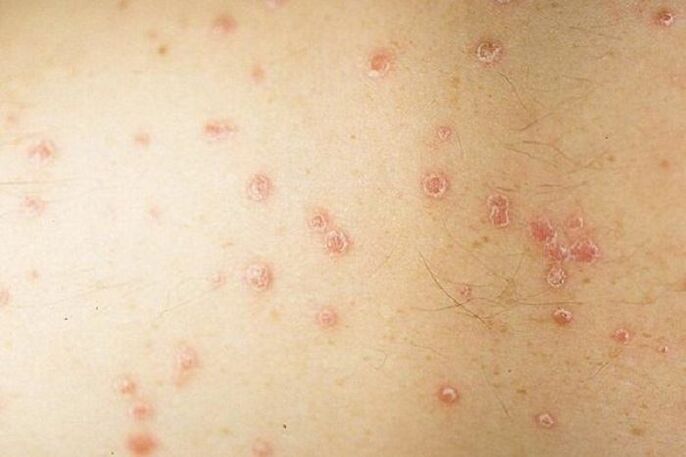 plankumainas psoriāzes simptomi