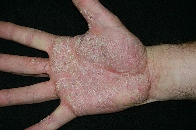plaukstu un pēdu psoriāze