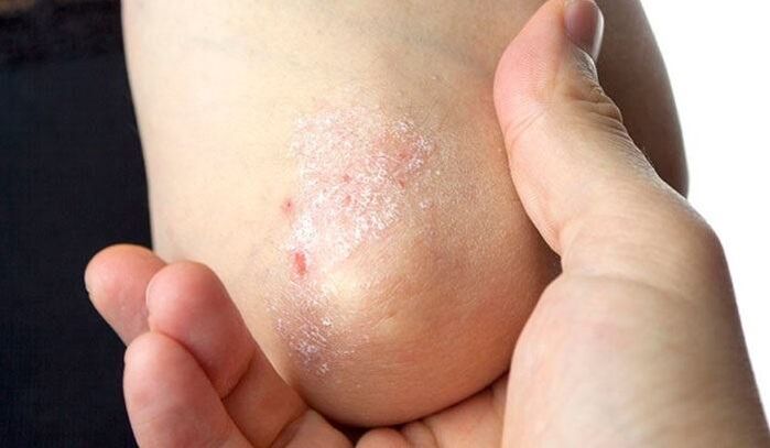 psoriāzes simptomi sākotnējā stadijā