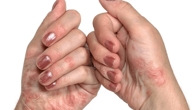 Sākotnējais psoriāzes posms
