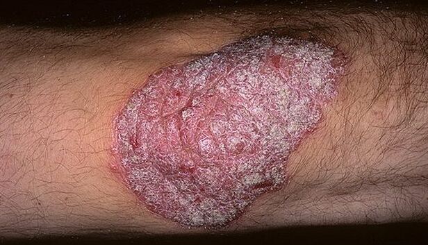 psoriāze